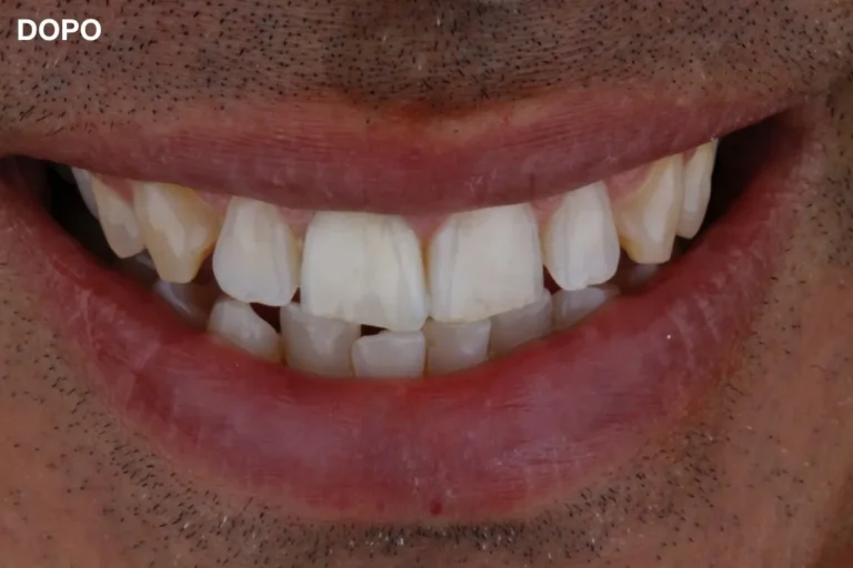 Denti prima e dopo 52 denti prima e dopo