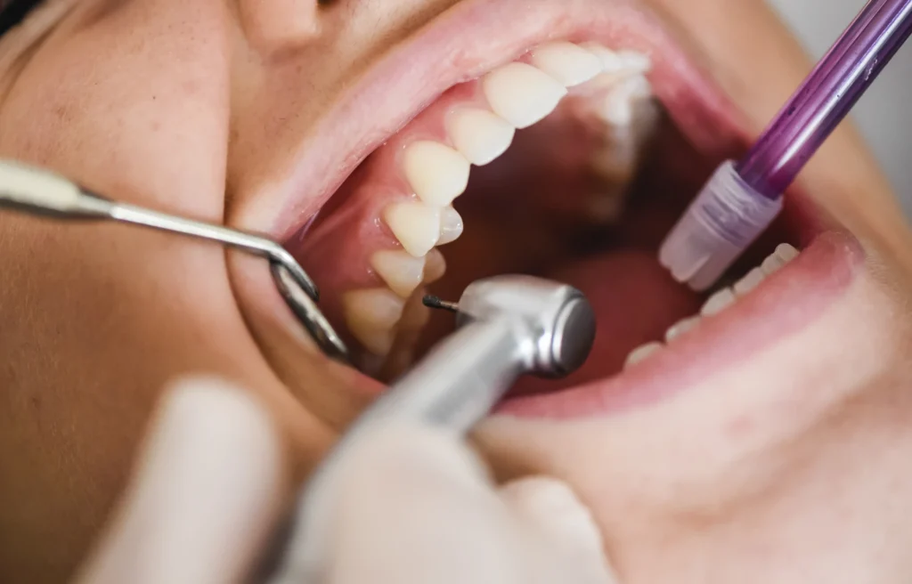 Mal di denti che non passa con antidolorifici: cosa fare? 1 mal di denti che non passa