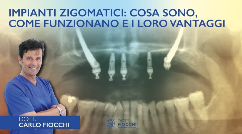 Impianti zigomatici cosa sono | Dott Fiocchi Clinica Odontoiatrica