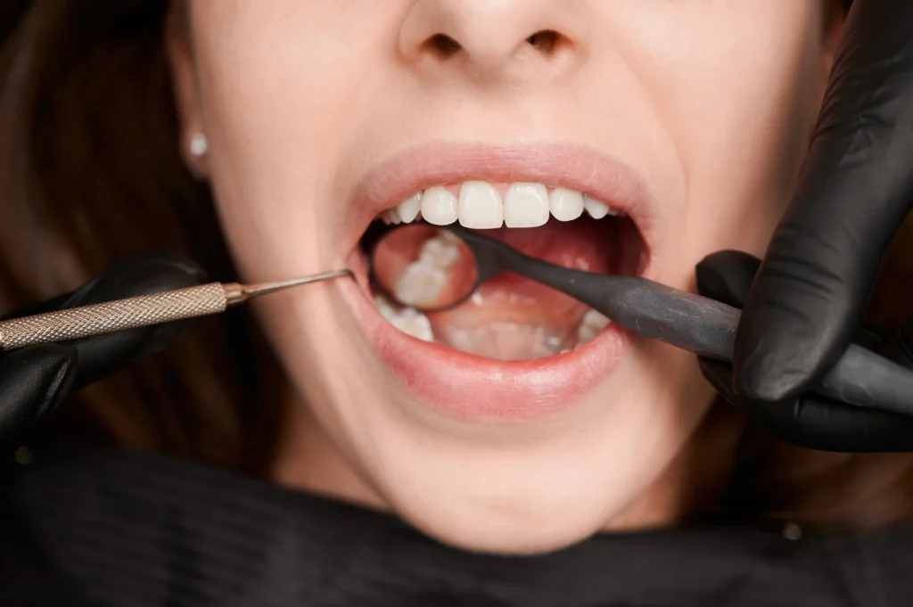 Pulizia dentale e prevenzione gengivite