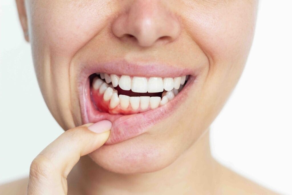 Prevenire la parodontite: lo spazzolamento corretto spiegato dai dentisti 1 Prevenire la parodontite